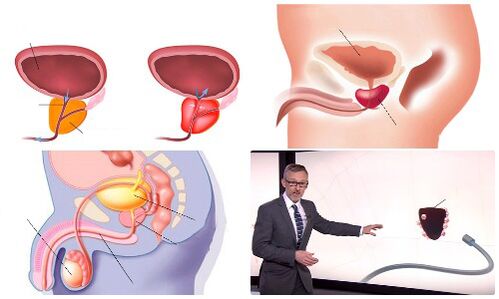 próstata saudável e doente